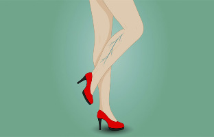 Варикозное расширение вен на ногах женщины