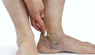 Проявления варикозного расширения вен на ногах